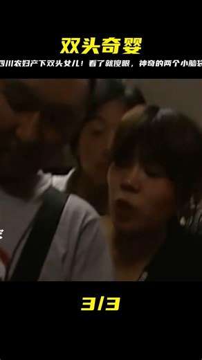 A Sichuan farmer gave birth to a conjoined twin girl with two spines, whose appearance is strikin...