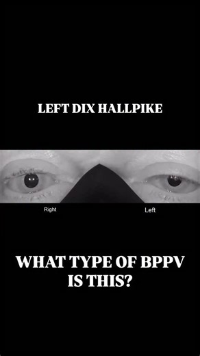 Advanced Neurologic Rehabilitation on Instagram: "In benign paroxysmal positional vertigo (BPPV), changes in head position cause displaced otoconia to shift within a semicircular canal. This alters endolymph dynamics and stimulates the corresponding vestibular receptors. During positional testing, these abnormal vestibular signals produce characteristic nystagmus. The direction, latency, and duration of the eye movements provide objective diagnostic information. By analyzing the nystagmus patter