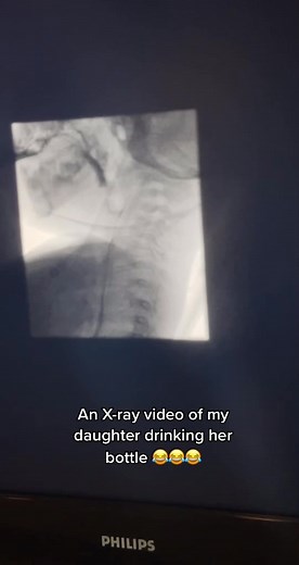 Adorable X-Ray Video of Baby Drinking From Bottle!