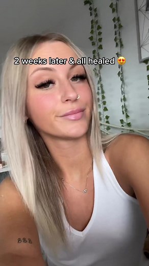 Enhancing Thin Lips with Lip Filler: Before & After Transformation