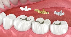 Dental fillings: ceramic, golden, metal. Dental 3D animation