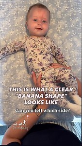 The banana shape is a sign of preferred side where the baby’s body bends to one side while the head tilts toward the same shoulder. One side of the body receives too many motor signals, while the other side is inhibited and receives fewer. This sweet baby has a banana shape toward her left side. Watch what happens when I try to extend the left side of her body in the video. When there’s such a big difference between the right and left sides, it’s essential to prevent further asymmetrical develop