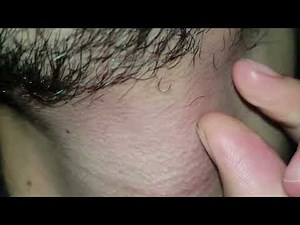 Ingrown hair removal skincare Transformation Blackheads removal #asmr #shorts #video #hair