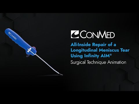 All-Inside Repair of a Longitudinal Meniscus Tear Using Infinity AIM™ - CONMED Animation