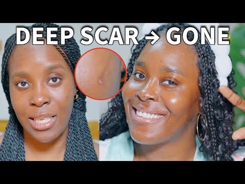 How This Deep Scar Healed Fast| Real Skin Healing Timeline| Jwillscool