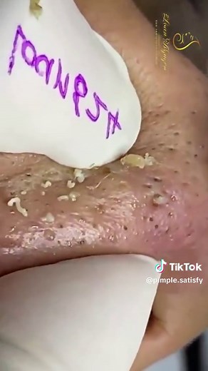 Giant Blackheads on Nose Removal