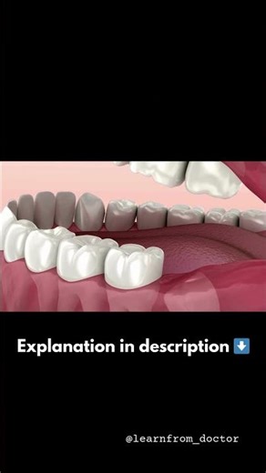 Why a Partially Erupted Wisdom Tooth Hurts | Explained #wisdomtooth #dentaleducation #shorts
