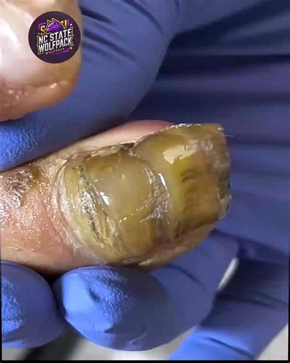 24K views · 137 reactions | Simple Steps to Support Overgrown Toenails That Reduce Pain Naturally #NailFixTips #ThickToenailCare #HomeNailCare #SafeNailCare | NC State Wolfpack on TheWolfpacker.com | Facebook