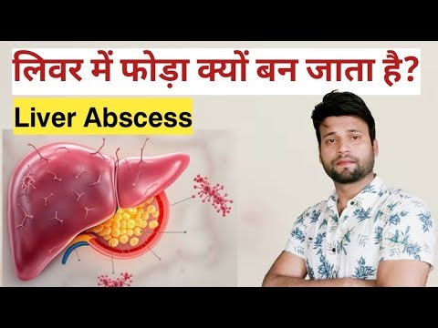 Liver में फोड़ा क्यों बनता है? | Liver Abscess के कारण, लक्षण और इलाज