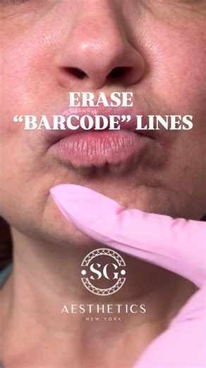 We already did upper lip “barcode” lines❤️. Now time for… Low lip “barcode” lines (also called perioral vertical lines) are the fine vertical wrinkles that form on the lower lip and just below it. Why they form • Orbicularis oris overactivity (repetitive puckering, talking, smoking) • Loss of collagen & elastin with age • Volume loss in the lip and perioral support • Skin thinning & dehydration • Sun damage • Post-menopausal estrogen decline #dermalfiller #antiaging #antiwrinkletreatment # | SG 