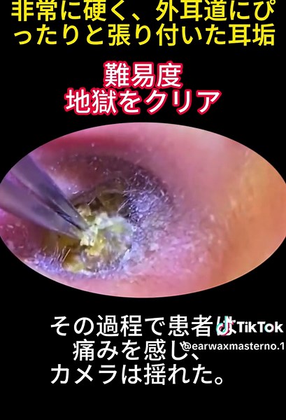 Earwax Removal Process: Cleaning Techniques Explained