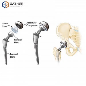 [Hot Item] Copa acetabular artificial de cadera de revisión Harmony personalizada OEM