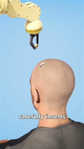 I Got The Neuralink Brain Chip