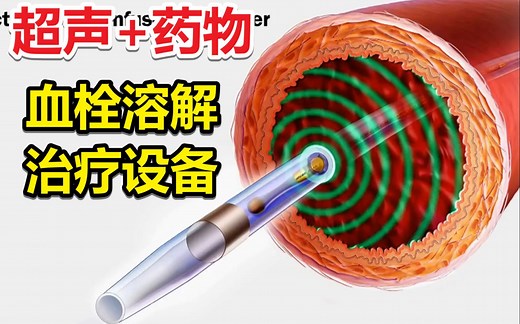 EkoSonic微创血管内超声治疗技术（人工双语字幕）