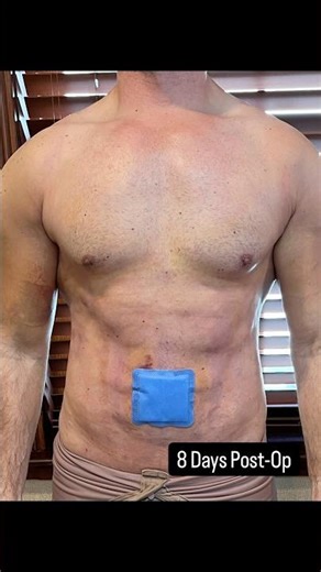 Pre-Op/2 Days Post-Op/8 Days Post-Op #bodytransformation #beforeandafter #plasticsurgery #male #body