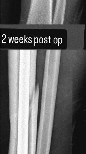 Tibia Fibula Fracture Recovery || The Road To Recovery || Tibia Fibula Femur bone Recovery