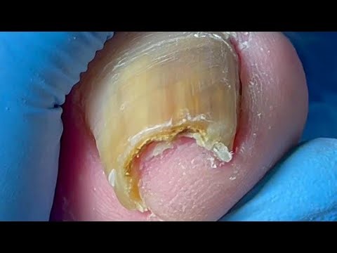 Extremely Curly Onychomycosis With Bacterial Infection Under The Nail