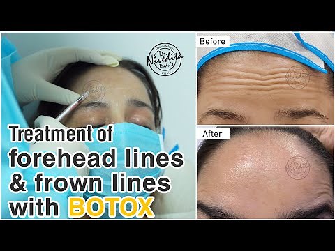 Botox Before And After | Botox Injections | Treatment of Forehead Lines and Frown Lines with Botox