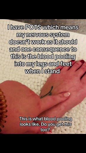 Autonomic dysfunction is real. There are different types of dysoutanomia and POTS ( postural outhostatic tachycardia syndrome ) is one of them. #chronicawareness #pots #posturalorthostatictachycardiasyndrome #bloodpooling #autonomicnervoussystem
