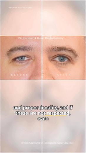 Dr Nick Koutroumanos | The Eye Guy on Instagram: "Aesthetic eye surgery is on the increase in men as refined, conservative and identity preserving techniques are becoming more prevalent. Male eyelid surgery isn’t a scaled-down version of the female operation. The anatomy, proportions, and aesthetic cues are different. A higher crease that looks refined in a woman can look exposed or incongruent in a man. Fat behaves differently, brow position carries more structural weight, and small changes in 