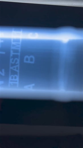 @Cirizawelding 🔍 April is National Welding Month! 🛠 Let’s dive into the fascinating world of non-destructive examination techniques. Ever wondered what’s behind the scenes of a butt weld? Behold, the captivating view of radiography, commonly known as X-ray examination. 📸 This technique ensures the quality and integrity of welds, especially those exposed to extreme conditions. Here’s a peek at a 2-inch carbon steel schedule 160 pipe weld under scrutiny. Isn’t it mesmerizing to see the blend of