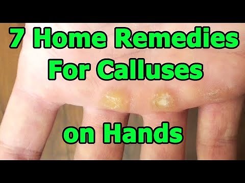 7 Home Remedies For Calluses on Your Hands That Anyone Can Use