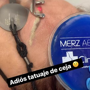 Láser Quanta System Discovery Pico para eliminar tatuaje de ceja. El láser de picosegundos solo elimina el pigmento sin quemar, marcas ni cicatrices. En nuestras fotos publicadas puedes encontrar ejemplos de antes y después. Contamos con la mejor tecnología para eliminar todo tipo de tatuajes y en cualquier área. #quantasystem #tattoo #tattooremoval #microblading #microshading #micropigmentacion #eliminaciondetatuajes #monterrey #medicinaestetica #aestheticmedicine | Clini-Medica Valle