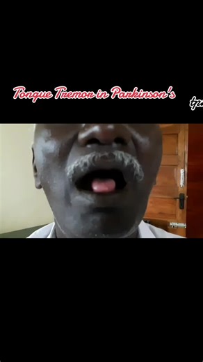 Understanding Tongue Tremor in Essential Tremor