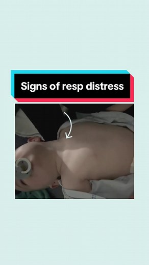 Signs your baby is struggling to breathe 👃 These are some signs of resporatory distress, and shows your baby is working hard to get oxygen into their bodies. #respiratorydistress #respiratorydistressinbabies #workofbreathing #rsv #flu #sick #virus #babycare