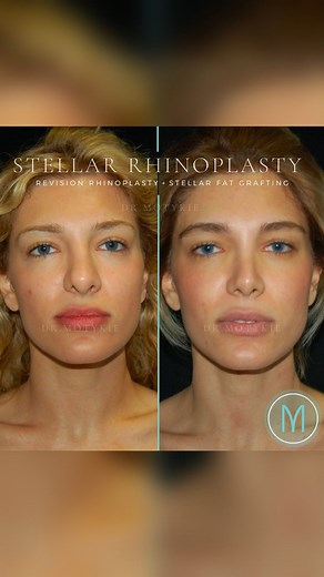 Gary Motykie, MD FACS on Instagram: "This 31-year-old patient underwent a revision rhinoplasty utilizing a closed (scarless) technique for nasal reshaping that included refinement of a large, wide nose with a bulbous, plunging nasal tip. The patient elected for Stellar fat grafting of her cheeks, underneath her eyes, and into her lips. I've shared additional angles to my stories today ☝ Individual results may vary. Rude comments directed toward the patient will not be tolerated."
