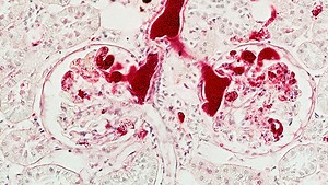 Kidney Transplant | Conditions & Treatments | UT Southwestern Medical Center