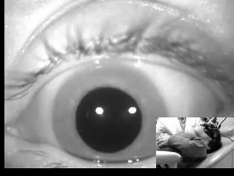 Congenital Nystagmus