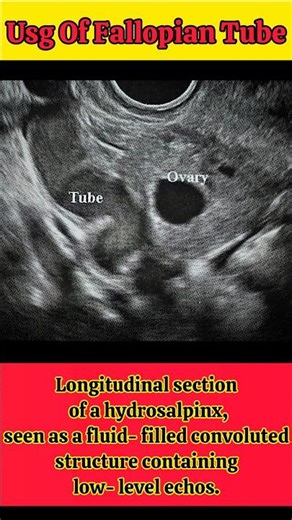 #hydrosalpinx