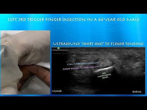 Ultrasound Guided Trigger Finger Injection by probeultrasound.com