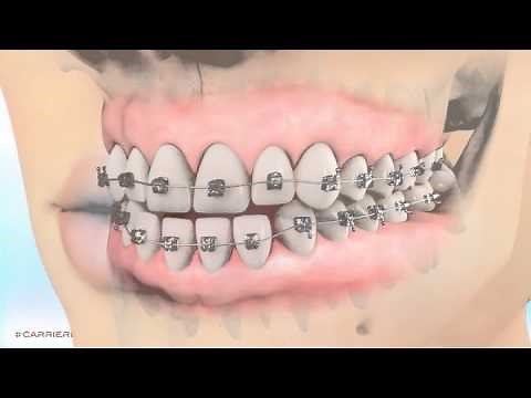 Carriere® Motion™ Appliance for Class III Patient Education! | Braces Orthodontist in Madison, GA