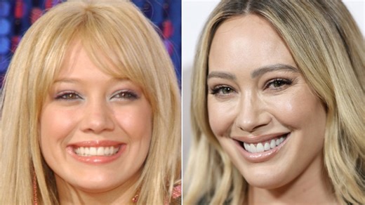 Before & after pics of Hilary Duff expose how chiseled her face has become