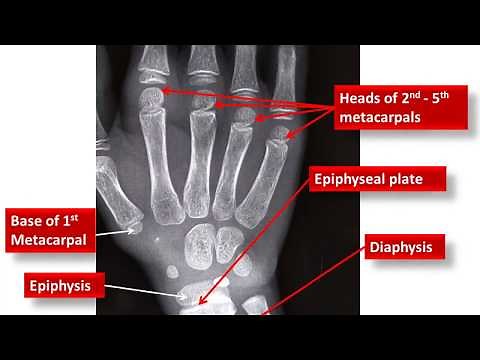 Age Estimation From Wrist X-ray