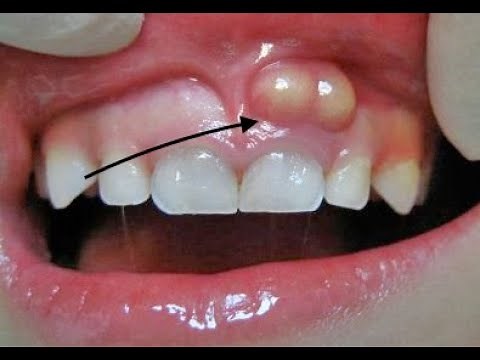 Incision and Drainage - and Penrose Drain Placement