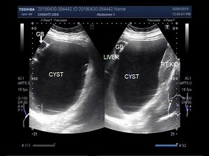 Ultrasound Video showing a large Hepatic hydatid Cyst.