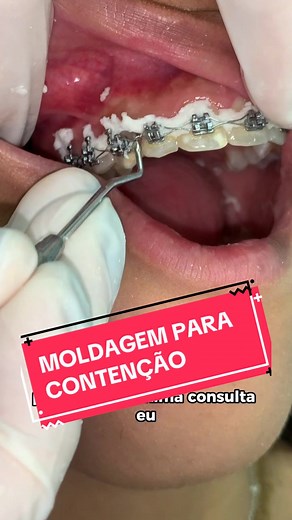 Moldagem para Contenção: Aparelho Móvel e Fixo