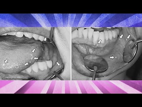 Squid Sperm Sacks Found in Woman’s Gums?