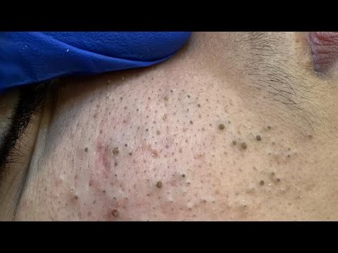 [ASMR] Pimple Popping And Extraction, Soothing Deep Facial Cleansing Routine