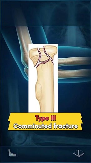 Radial Head Fracture Mason Classification | Orthopaedics Exam Pearl #shorts