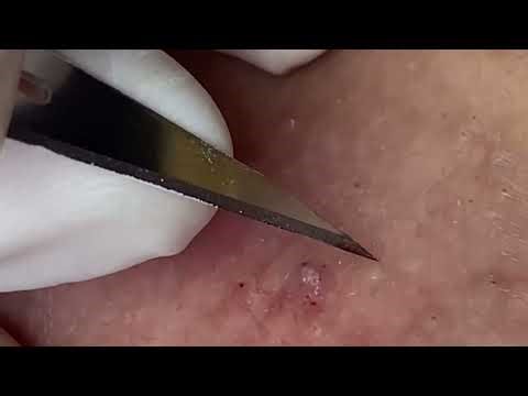 Pimple Popping #pimplepopping & Blackhead Extraction Compilation | Satisfying Acne Removal Close#032