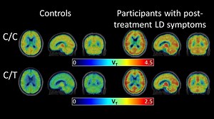 New Scan Technique Reveals Brain Inflammation Associated with Post-Treatment Lyme disease Syndrome