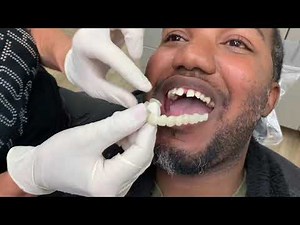 Houston Cosmetic Dentist ...How to close those gaps without braces affordably!!