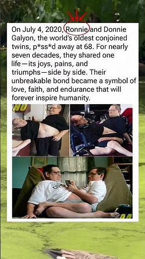 68 Years World’s Oldest Conjoined Twins — The Unbelievable Life of Ronnie and Donnie