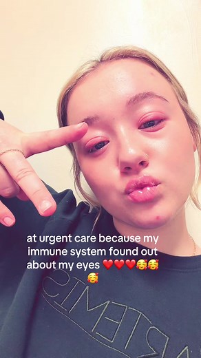 Aleah Grace🐝 (@avonblohn8)’s video of immune system attack on eyes