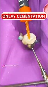 Rubber Dam Placement + Onlay Cementation Protocol 🦷 #shorts