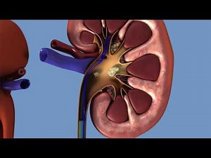 Ureteroscopy: Step-by-Step Guide to Minimally Invasive Kidney Stone Removal
